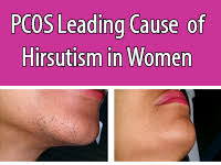 Laser hair removal has been proposed as treatment for the hirsute patient, however most studies have been uncontrolled and included fewer than 50 patients, none have been blinded, and all have used a variety of treatment protocols, equipment, skin types, and hair colors studied. Pcos Leading Cause Of Hirsutism In Women Amerejuve Medspa