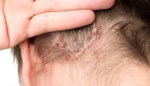inflammation of the scalp hair