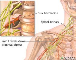 neck pain information mount sinai
