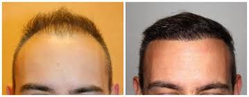 Photos avant & après une greffe de cheveux FUE - Docteur Eric Bouhanna