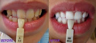 teeth whitening