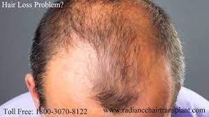 Lee ws, ro bi, hong sp et al (2007) a new classification of pattern hair loss that is universal for men and women: Pin On Stop Hair Loss And Feel Great