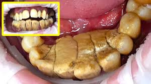 remove tartar from teeth without