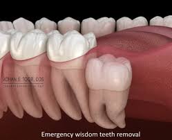 emergency wisdom teeth removal