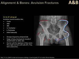 White on an xray is from something that blocks the xrays from going through, so that spot has to be hard and calcified. Trauma Image Interpretation Of The Pelvis And Hip Radiographs Using