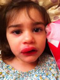 busted lip picture babycenter