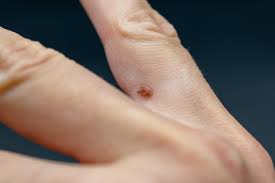 papilloma on finger common wart verruca