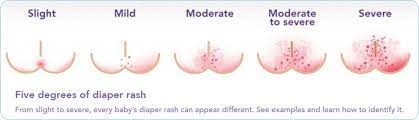 baby diaper rash treatment guide