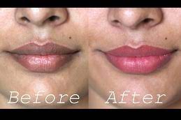 best dark lips treatment in abad