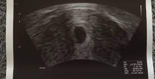Manchmal ist diese kleine blase schon im ultraschall sichtbar, oft sieht der arzt zu diesem zeitpunkt nur eine besonders hoch aufgebaute gebärmutterschleimhaut. Verdacht Auf Elss Schwanger Wer Noch