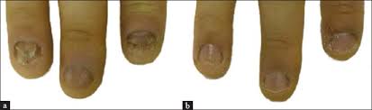 treatment of paediatric nail dystrophy