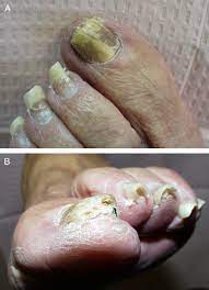 topical antifungal nail lacquer