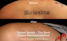 The method of tattoo removal has changed over the years. The Tattoo Vanish Method Learn Why No Other Tattoo Removal Method Compares Tattoo Removal Without Laser Laserless Painless Non Laser Tattoo Removal Near Me Tattoo Vanish