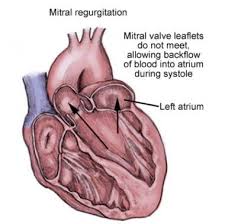 (usmle topics, cardiology) mitral (bicuspid) valve diseases: Percutaneous Mitral Valve Repair Background Indications