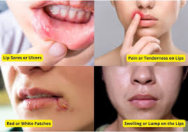 lip cancer 5 symptoms causes treatment