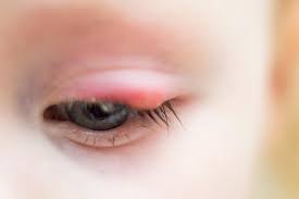 how to prevent and treat styes abc