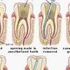 Nyeri gigi berdenyut juga bisa terjadi plak yang menempel pada gigi dapat mengeras di bawah atau di atas garis gusi sehingga bagi banyak orang, berkumur dengan air garam dapat digunakan sebagai salah satu cara. 1