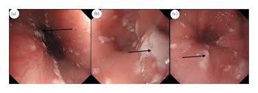 esophageal candidiasis