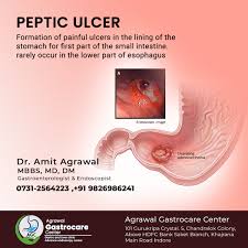 what is peptic ulcer treatment