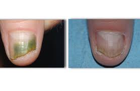 toenail fungus onychomycosis infection