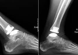 total ankle arthroplasty offers