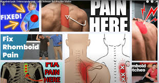 rhomboid pain interscar pain