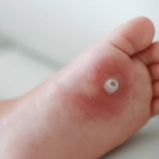 wart treatment cherrywood foot care