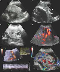 Gray Scale And Color Doppler Images Illustrating Criteria