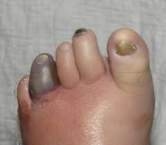 blue or purple toe syndrome