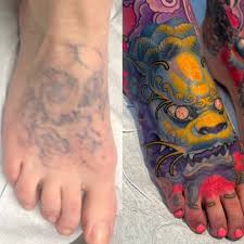 laser tattoo removal vancouver
