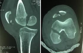 distal femur fractures trauma