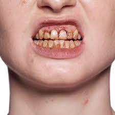 tooth enamel kryolan professional