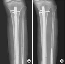 an intramedullary nail with oblique