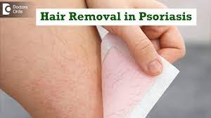 hair removal in psoriasis safest way