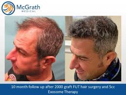 How does it compare to other hair restoration methods? Before After Hair Transplant Photos Mcgrath Medical Austin Tx