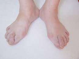 foot problems from overlapping toes