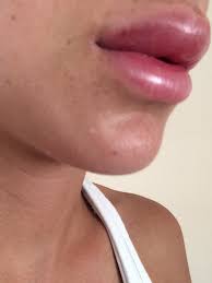 post restylane injections to my lips