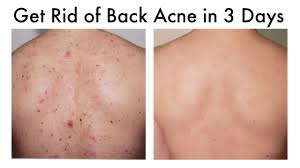 how to get rid of back acne at home in