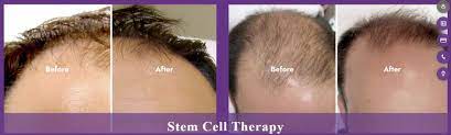 stem cell hair treatment