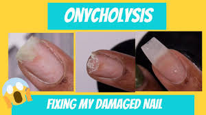 onycholysis uuggghh i damaged my nail