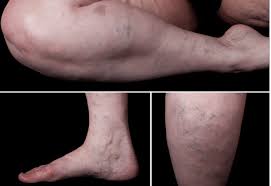 spider veins and venous manifestations