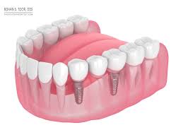 partial dentures process problems