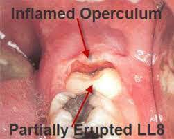 what is pericoronitis