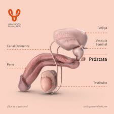 cáncer de próstata urólogos en vallarta