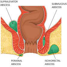 rectal abscess and fistulas dr