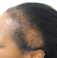 It may be congenital or acquired, circumscribed or diffuse, and cicatricial or nonscarring. What Helps Your Hair Grow Back From Traction Alopecia Quora