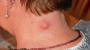 hard lump under skin 8 causes and how