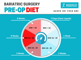 bariatric surgery pre op t guide