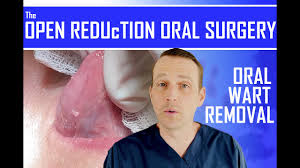 mouth std wart surgical removal