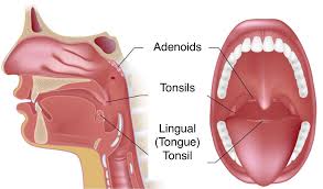 tonsil hypertrophy